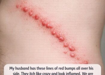 My husband has these lines of red bumps all over his side. They itch like crazy and look inflamed. We are scared it’s an infection. What is this?